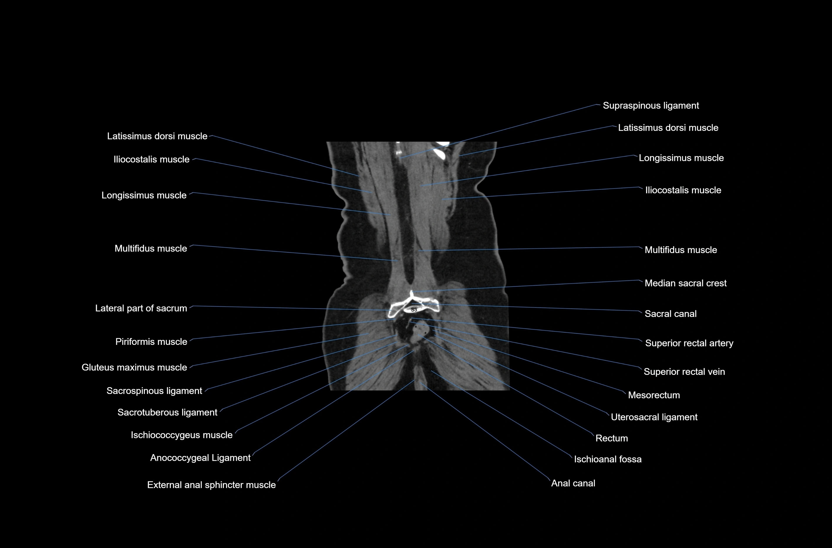 CT abdomen coronal cross sectional anatomy labelled radiology image-00077.webp